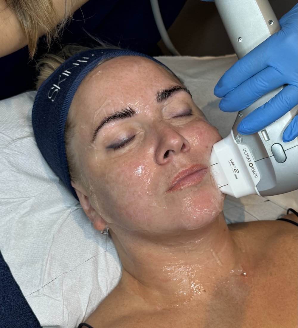 Client receiving a HIFU Ultraformer III Non-Surgical Face Lift at SKIN lounge Aesthetics Richmond Hill, using focused ultrasound technology to lift, firm, and contour the face for a youthful, rejuvenated appearance without surgery or downtime.
