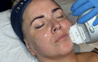 HIFU Ultraformer III Non-Surgical Face Lift – SKIN lounge Aesthetics Richmond Hill Client receiving a HIFU Ultraformer III Non-Surgical Face Lift at SKIN lounge Aesthetics Richmond Hill, using focused ultrasound technology to lift, firm, and contour the face for a youthful, rejuvenated appearance without surgery or downtime.