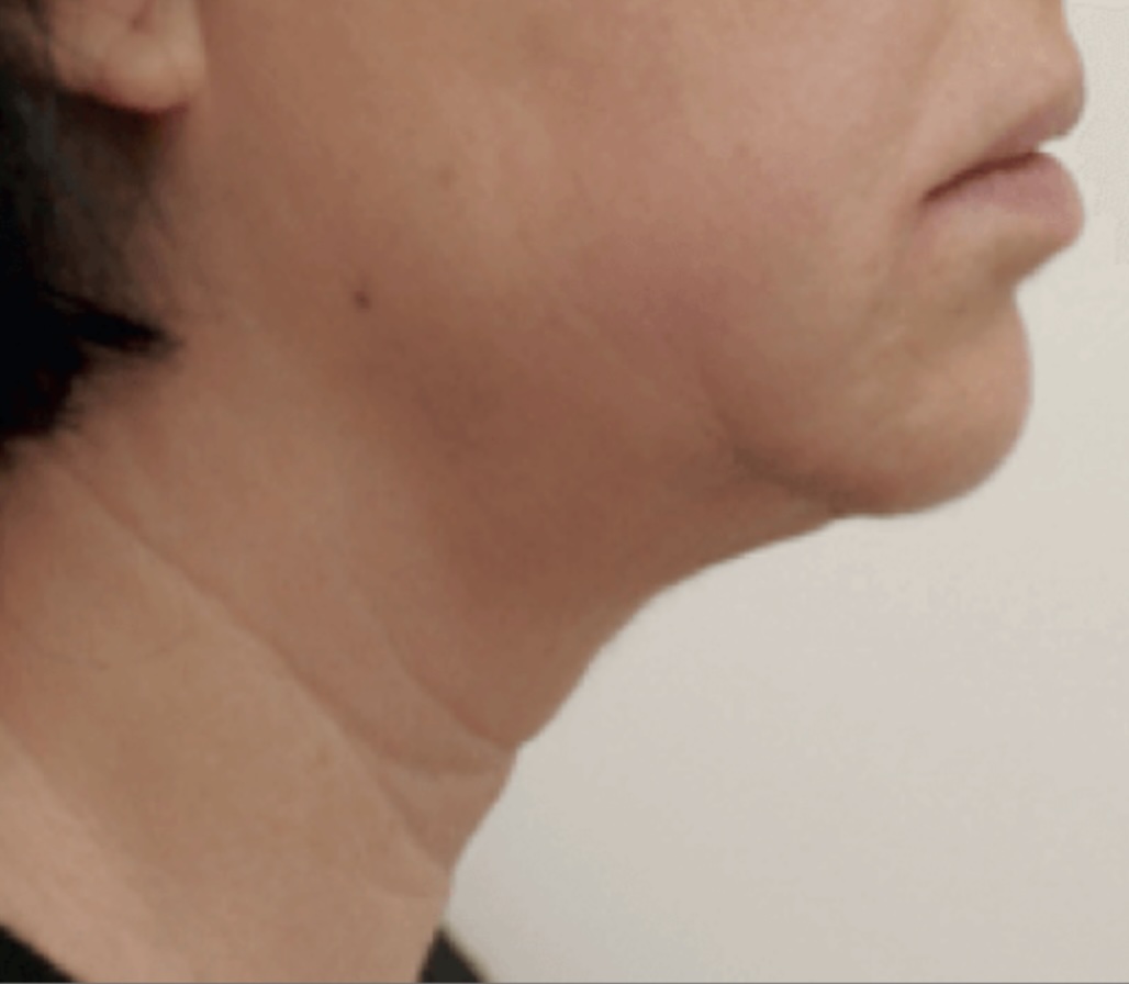Client receiving a HIFU Ultraformer III Non-Surgical Face Lift at SKIN lounge Aesthetics Richmond Hill, using focused ultrasound technology to lift, firm, and contour the face for a youthful, rejuvenated appearance without surgery or downtime.