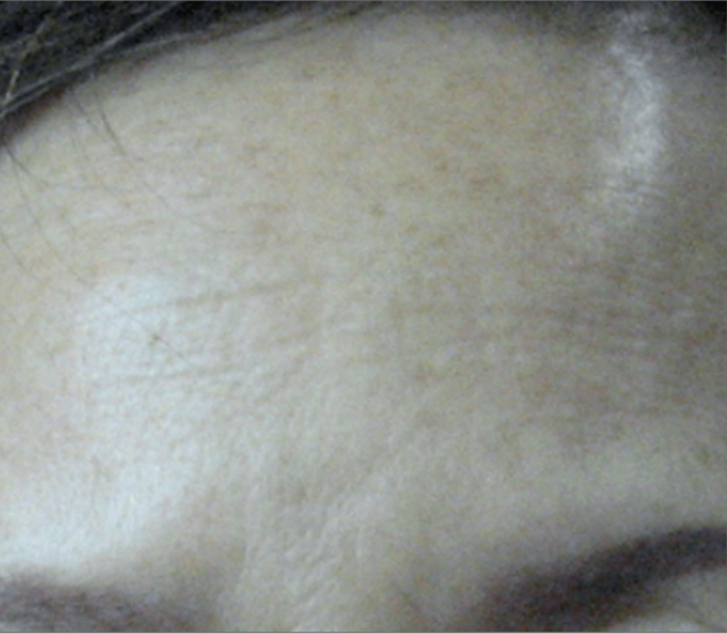 Client receiving a HIFU Ultraformer III Non-Surgical Face Lift at SKIN lounge Aesthetics Richmond Hill, using focused ultrasound technology to lift, firm, and contour the face for a youthful, rejuvenated appearance without surgery or downtime.
