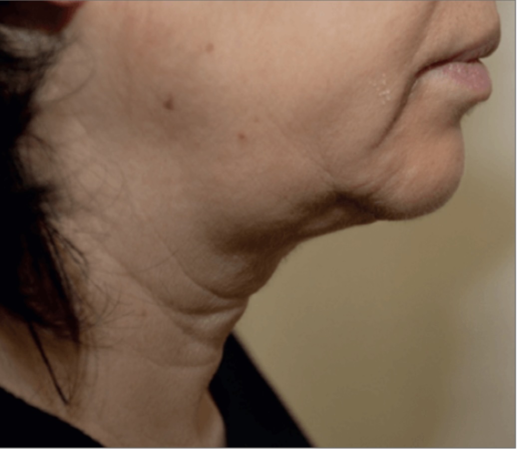 Client receiving a HIFU Ultraformer III Non-Surgical Face Lift at SKIN lounge Aesthetics Richmond Hill, using focused ultrasound technology to lift, firm, and contour the face for a youthful, rejuvenated appearance without surgery or downtime.