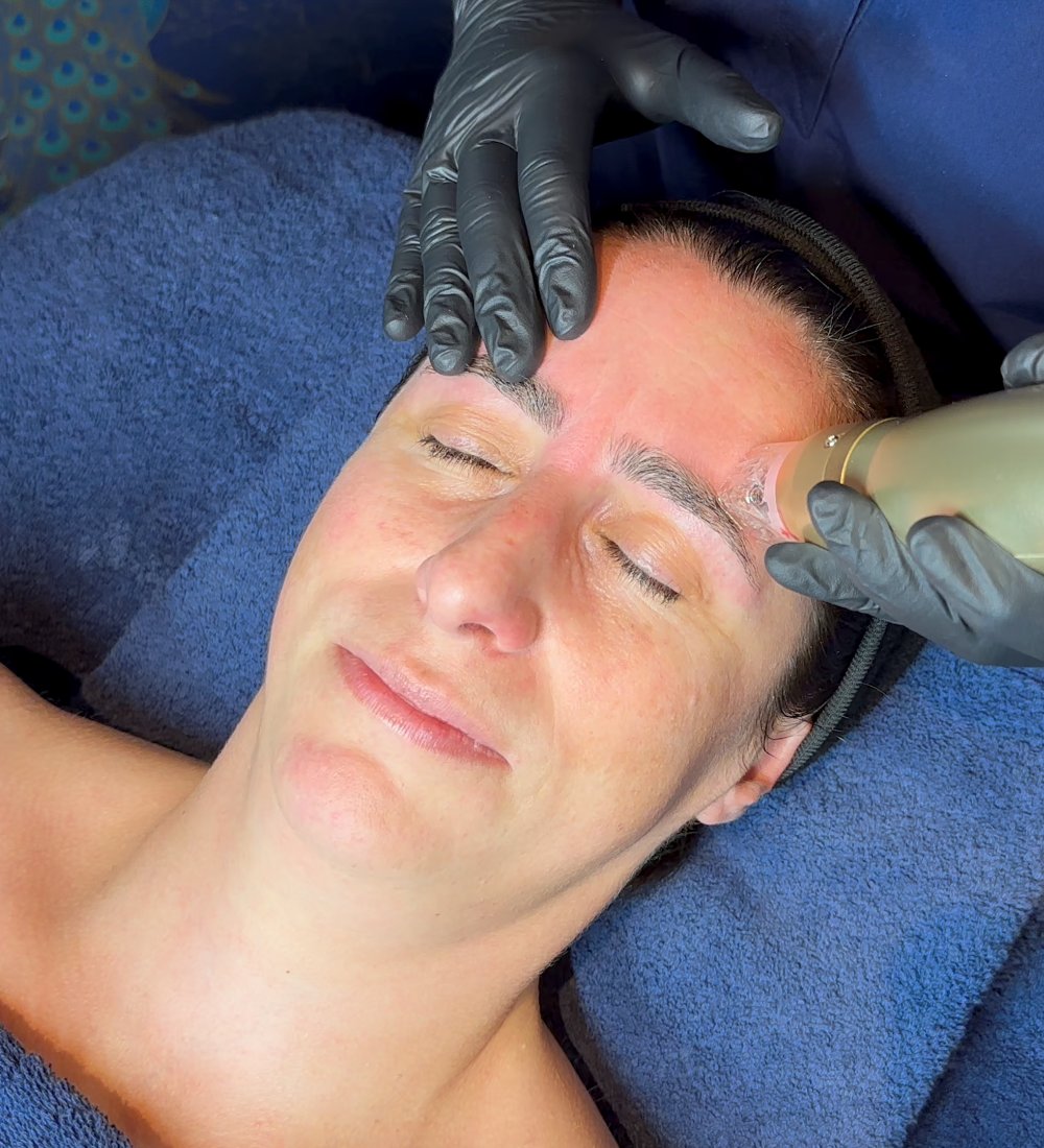 Client receiving Sylfirm X RF Microneedling with ASCE Rose Exosomes at SKIN lounge Aesthetics Richmond Hill, combining radiofrequency energy and regenerative exosome technology to smooth fine lines, tighten skin, and enhance overall radiance and texture.