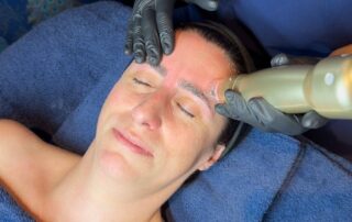 Sylfirm X RF Microneedling with ASCE Rose Exosomes – SKIN lounge Aesthetics Richmond Hill Client receiving Sylfirm X RF Microneedling with ASCE Rose Exosomes at SKIN lounge Aesthetics Richmond Hill, combining radiofrequency energy and regenerative exosome technology to smooth fine lines, tighten skin, and enhance overall radiance and texture.