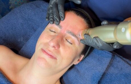 Sylfirm X RF Microneedling with ASCE Rose Exosomes – SKIN lounge Aesthetics Richmond Hill Client receiving Sylfirm X RF Microneedling with ASCE Rose Exosomes at SKIN lounge Aesthetics Richmond Hill, combining radiofrequency energy and regenerative exosome technology to smooth fine lines, tighten skin, and enhance overall radiance and texture.