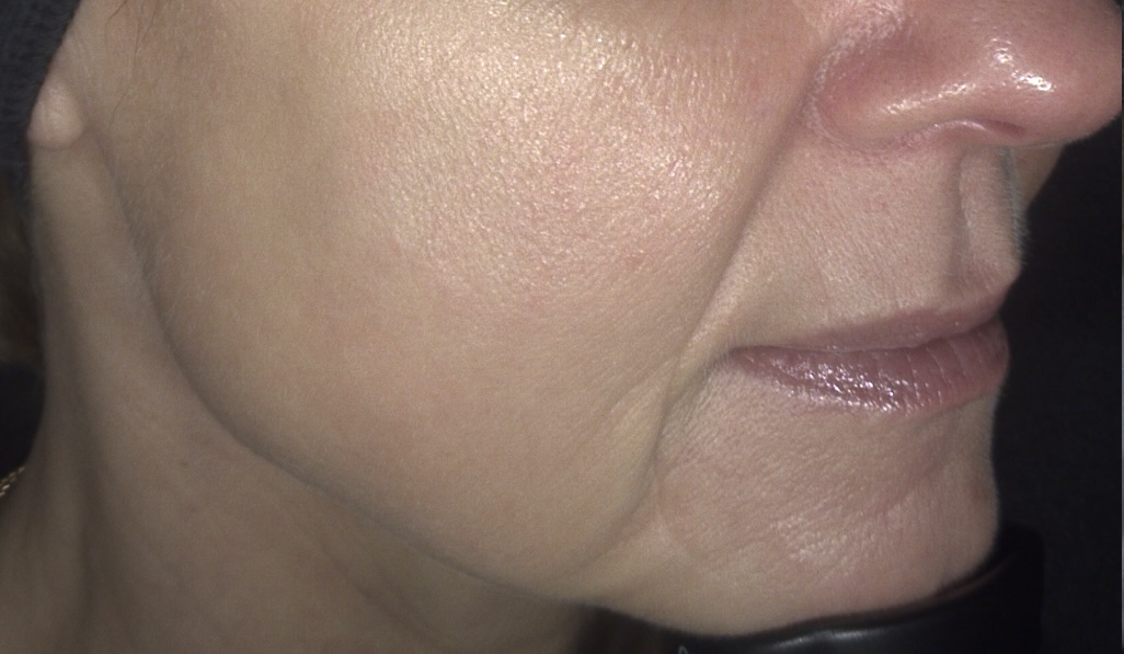 Client receiving Sylfirm X RF Microneedling with ASCE Rose Exosomes at SKIN lounge Aesthetics Richmond Hill, combining radiofrequency energy and regenerative exosome technology to smooth fine lines, tighten skin, and enhance overall radiance and texture.