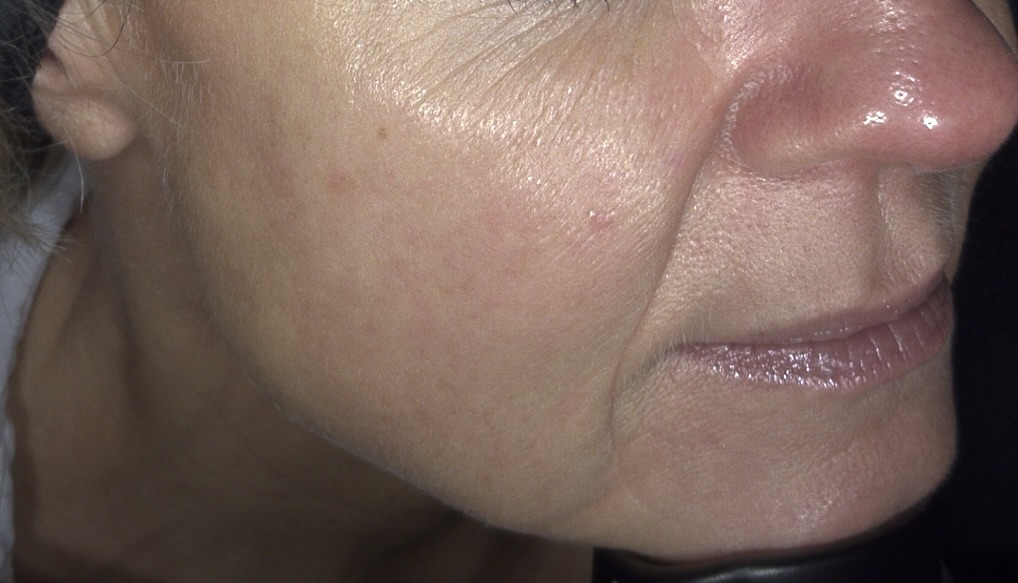 Client receiving Sylfirm X RF Microneedling with ASCE Rose Exosomes at SKIN lounge Aesthetics Richmond Hill, combining radiofrequency energy and regenerative exosome technology to smooth fine lines, tighten skin, and enhance overall radiance and texture.