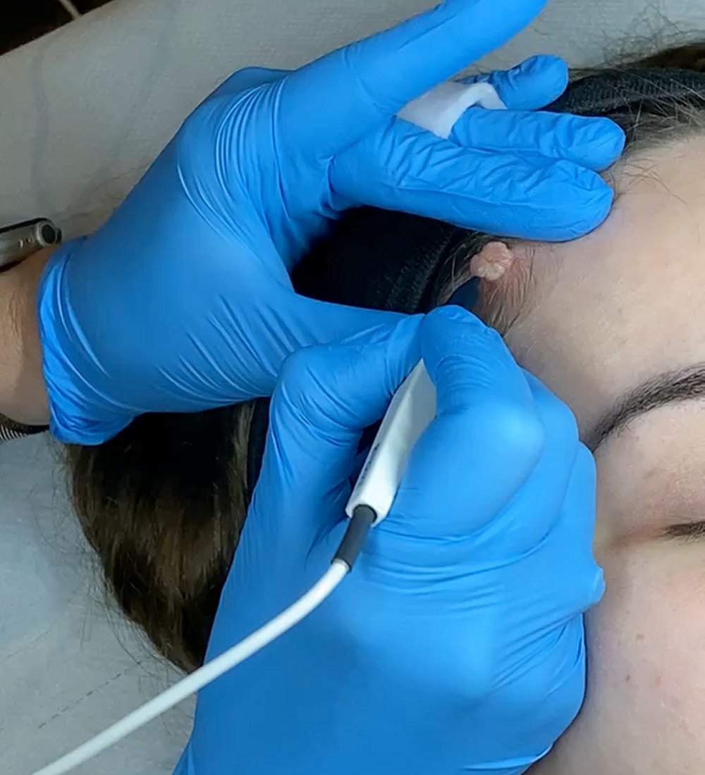 Client receiving Sterex electrolysis blemish removal treatment at SKIN lounge Aesthetics Richmond, using precision electrical currents to safely remove skin tags, thread veins, and other minor blemishes.