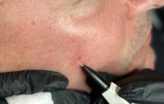 Client receiving Sterex electrolysis blemish removal treatment at SKIN lounge Aesthetics Richmond, using precision electrical currents to safely remove skin tags, thread veins, and other minor blemishes. Client receiving Sterex electrolysis blemish removal treatment at SKIN lounge Aesthetics Richmond, using precision electrical currents to safely remove skin tags, thread veins, and other minor blemishes.
