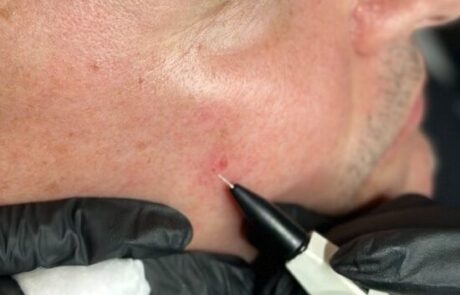 Client receiving Sterex electrolysis blemish removal treatment at SKIN lounge Aesthetics Richmond, using precision electrical currents to safely remove skin tags, thread veins, and other minor blemishes. Client receiving Sterex electrolysis blemish removal treatment at SKIN lounge Aesthetics Richmond, using precision electrical currents to safely remove skin tags, thread veins, and other minor blemishes.