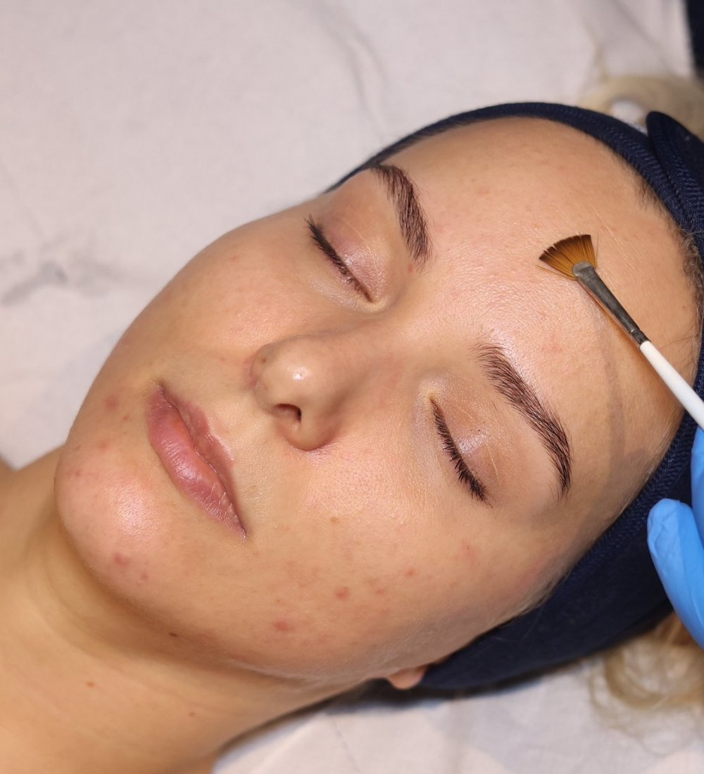 Client receiving a Bespoke AlumierMD Peel at SKIN lounge Aesthetics Richmond, a customised chemical peel treatment that gently exfoliates and rejuvenates the skin for a glowing, even-toned finish.