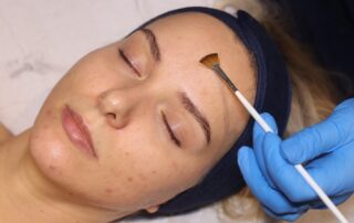 Bespoke AlumierMD Peel – SKIN lounge Aesthetics Richmond Client receiving a Bespoke AlumierMD Peel at SKIN lounge Aesthetics Richmond, a customised chemical peel treatment that gently exfoliates and rejuvenates the skin for a glowing, even-toned finish.