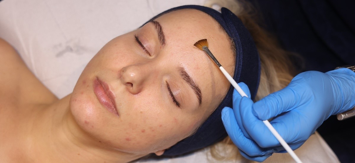Bespoke AlumierMD Peel – SKIN lounge Aesthetics Richmond Client receiving a Bespoke AlumierMD Peel at SKIN lounge Aesthetics Richmond, a customised chemical peel treatment that gently exfoliates and rejuvenates the skin for a glowing, even-toned finish.
