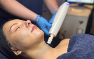 Harmony XL PRO ClearLift – SKIN lounge Aesthetics Richmond Client receiving Harmony XL PRO ClearLift treatment at SKIN lounge Aesthetics Richmond, using advanced fractional laser technology to lift, tone, and revitalise the skin without downtime.