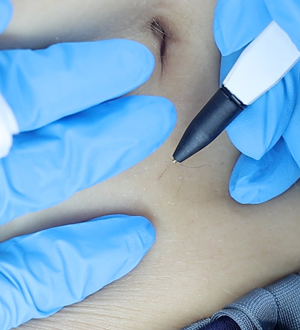 Client receiving Sterex electrolysis hair removal at SKIN lounge Aesthetics Richmond, using a precise electrical current to permanently remove unwanted hair safely and effectively.