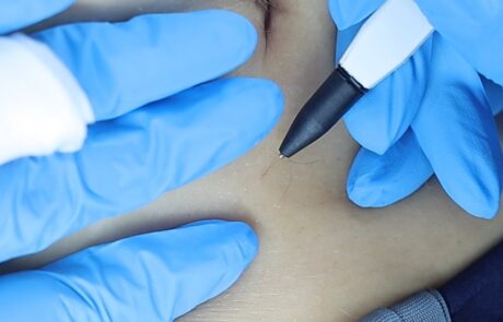 Sterex Electrolysis Hair Removal – SKIN lounge Aesthetics Richmond Client receiving Sterex electrolysis hair removal at SKIN lounge Aesthetics Richmond, using a precise electrical current to permanently remove unwanted hair safely and effectively.