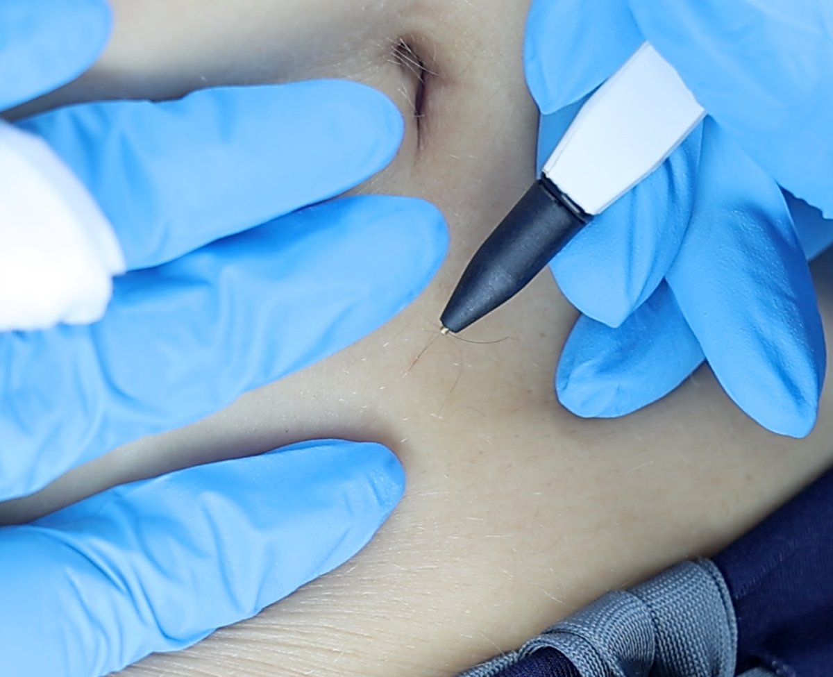 Sterex Electrolysis Hair Removal – SKIN lounge Aesthetics Richmond Client receiving Sterex electrolysis hair removal at SKIN lounge Aesthetics Richmond, using a precise electrical current to permanently remove unwanted hair safely and effectively.