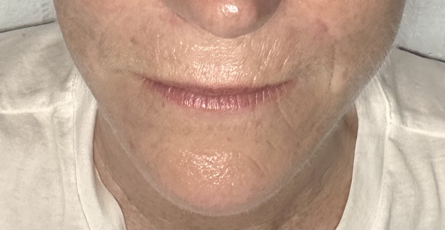 Client enjoying a HydraLift facial at SKIN lounge Aesthetics Richmond Hill, combining advanced Hydra technology with HIFU Ultraformer III to deeply cleanse, hydrate, lift, and firm the skin for remarkable anti-ageing and rejuvenating results.