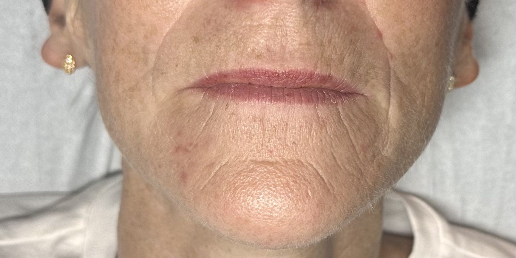 Client enjoying a HydraLift facial at SKIN lounge Aesthetics Richmond Hill, combining advanced Hydra technology with HIFU Ultraformer III to deeply cleanse, hydrate, lift, and firm the skin for remarkable anti-ageing and rejuvenating results.