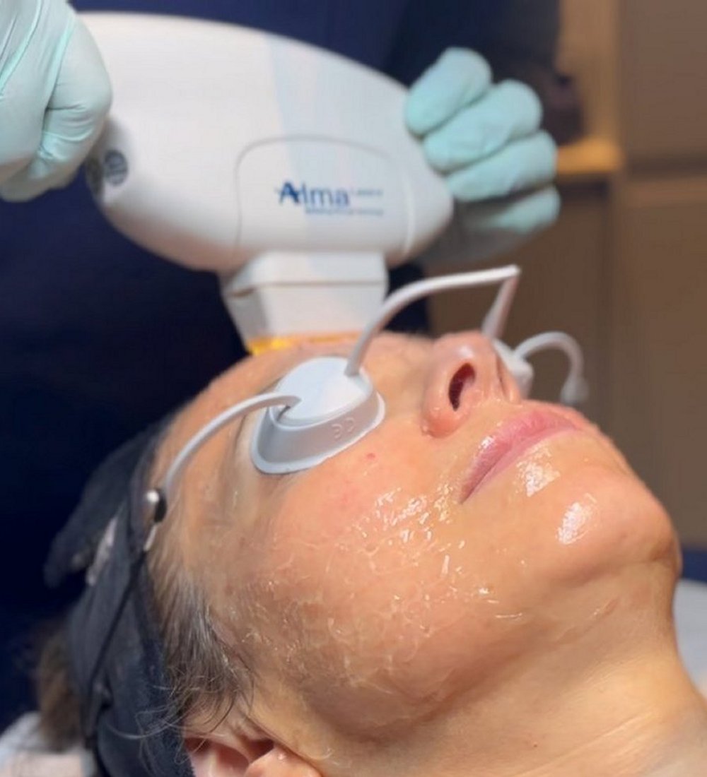 Client receiving Harmony XL PRO IPL Skin Rejuvenation at SKIN lounge Aesthetics Richmond, using advanced light technology to improve skin texture, reduce pigmentation, and enhance overall radiance.