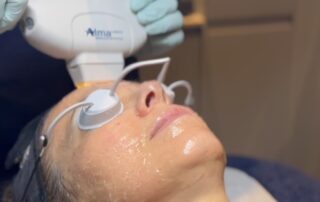 Harmony XL PRO IPL Skin Rejuvenation – SKIN lounge Aesthetics Richmond Client receiving Harmony XL PRO IPL Skin Rejuvenation at SKIN lounge Aesthetics Richmond, using advanced light technology to improve skin texture, reduce pigmentation, and enhance overall radiance.