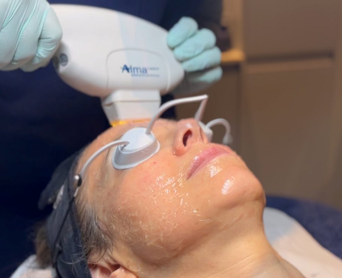 Harmony XL PRO IPL Skin Rejuvenation – SKIN lounge Aesthetics Richmond Client receiving Harmony XL PRO IPL Skin Rejuvenation at SKIN lounge Aesthetics Richmond, using advanced light technology to improve skin texture, reduce pigmentation, and enhance overall radiance.