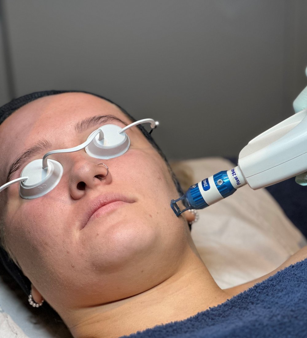 Client receiving Harmony XL PRO iPixel laser resurfacing treatment at SKIN lounge Aesthetics Richmond, targeting fine lines, sun damage, and uneven skin texture for a smoother, radiant complexion.