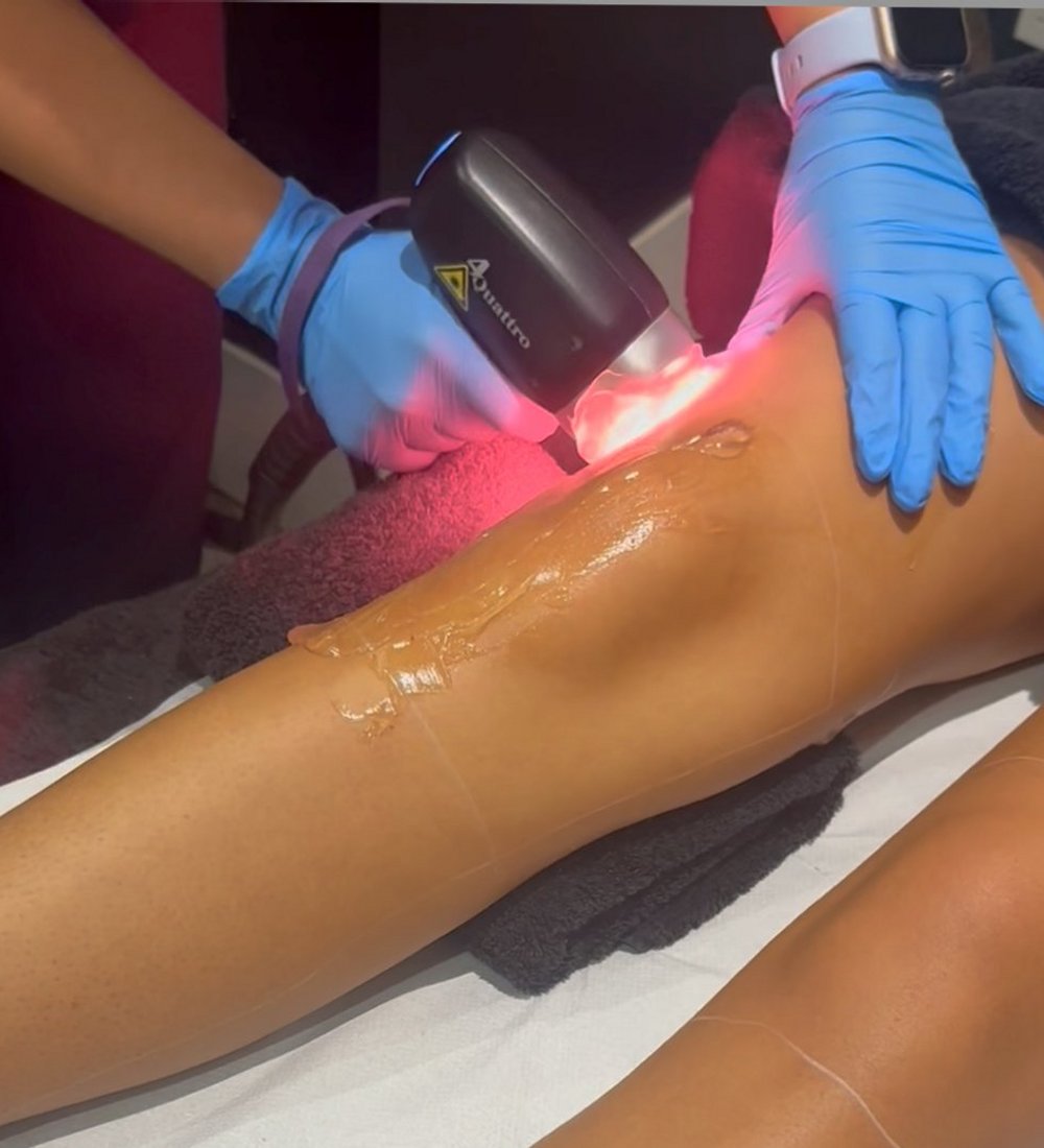 Client receiving Soprano Titanium laser hair removal at SKIN lounge Aesthetics Richmond, using advanced technology for safe, comfortable, and effective hair reduction.