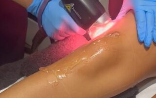 Laser Hair Removal 1200×500 Client receiving Soprano Titanium laser hair removal at SKIN lounge Aesthetics Richmond, using advanced technology for safe, comfortable, and effective hair reduction.