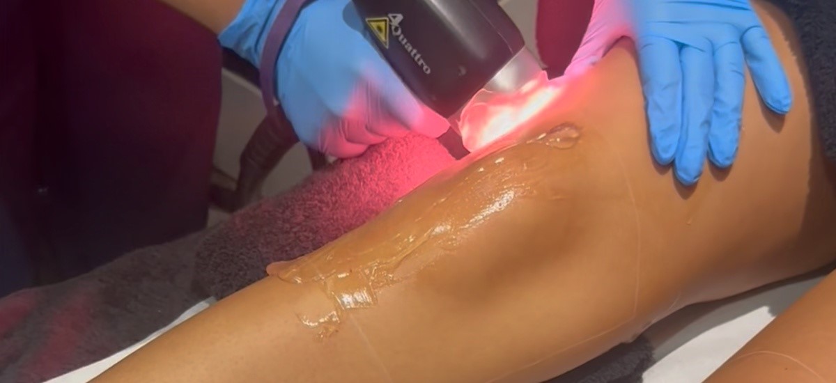 Client receiving Soprano Titanium laser hair removal at SKIN lounge Aesthetics Richmond, using advanced technology for safe, comfortable, and effective hair reduction.