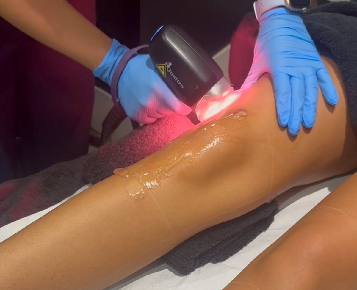 Laser Hair Removal 1200×975 Client receiving Soprano Titanium laser hair removal at SKIN lounge Aesthetics Richmond, using advanced technology for safe, comfortable, and effective hair reduction.