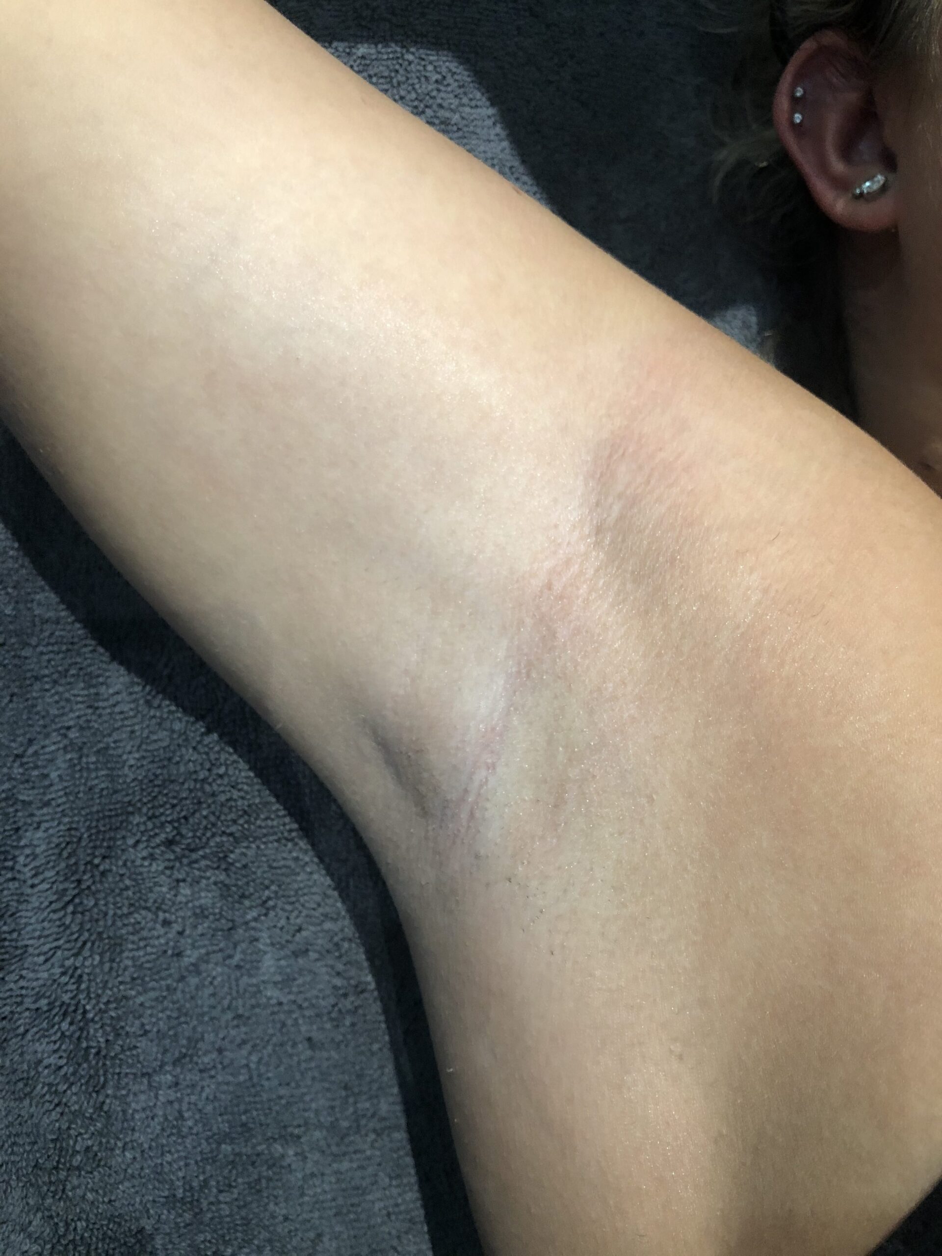 Client receiving Soprano Titanium laser hair removal at SKIN lounge Aesthetics Richmond, using advanced technology for safe, comfortable, and effective hair reduction.