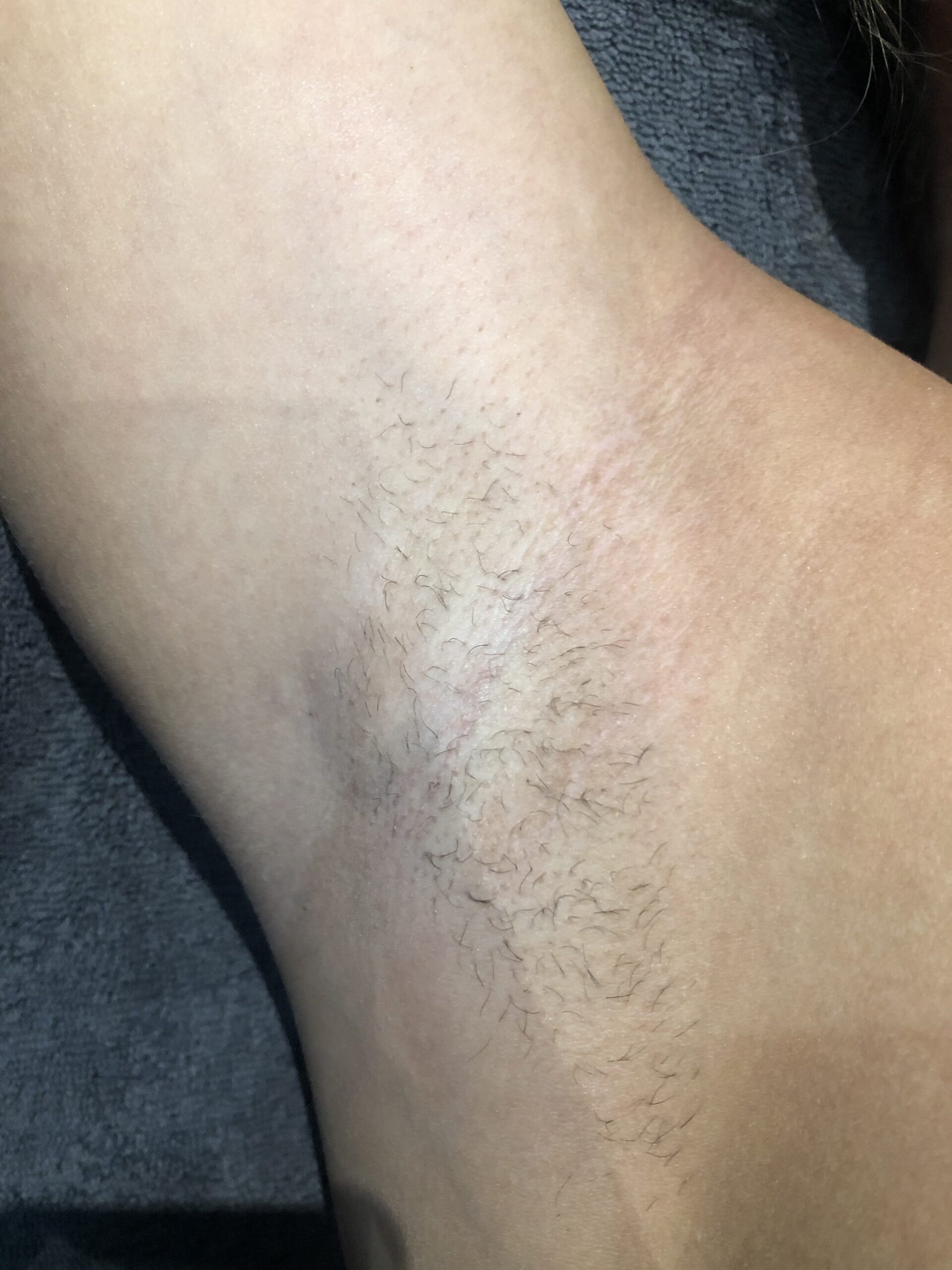 Client receiving Soprano Titanium laser hair removal at SKIN lounge Aesthetics Richmond, using advanced technology for safe, comfortable, and effective hair reduction.