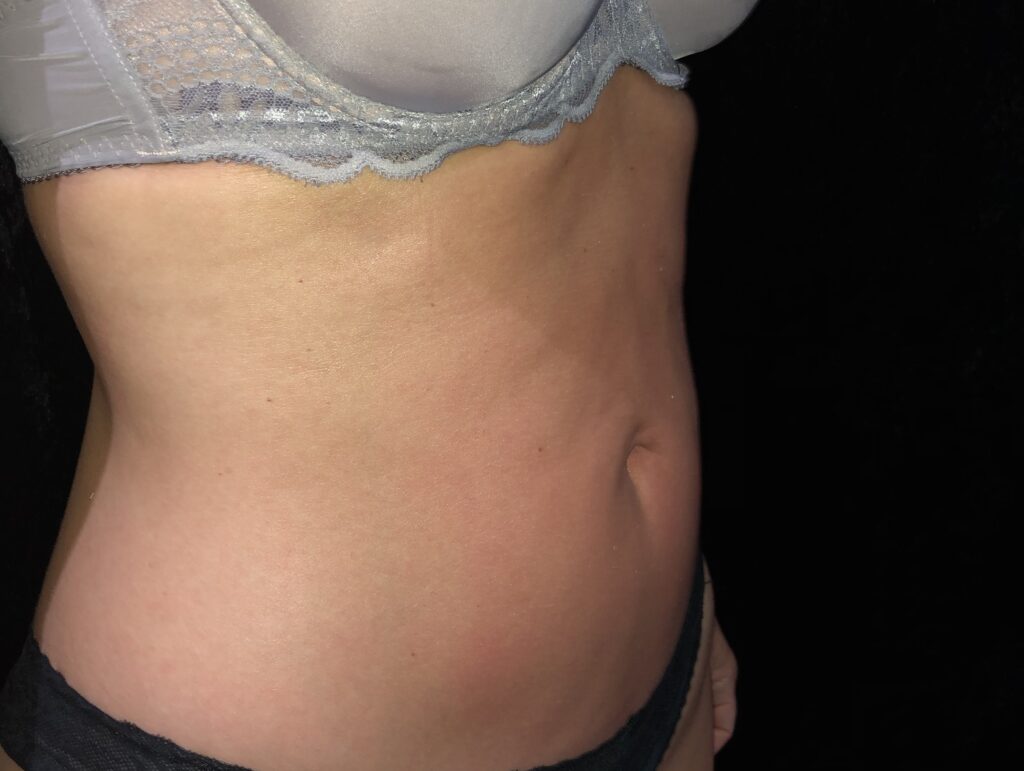 Client receiving T-Shape body sculpting and cellulite reduction treatment at SKIN lounge Aesthetics Richmond, using advanced multi-technology to firm, smooth, and contour the body.