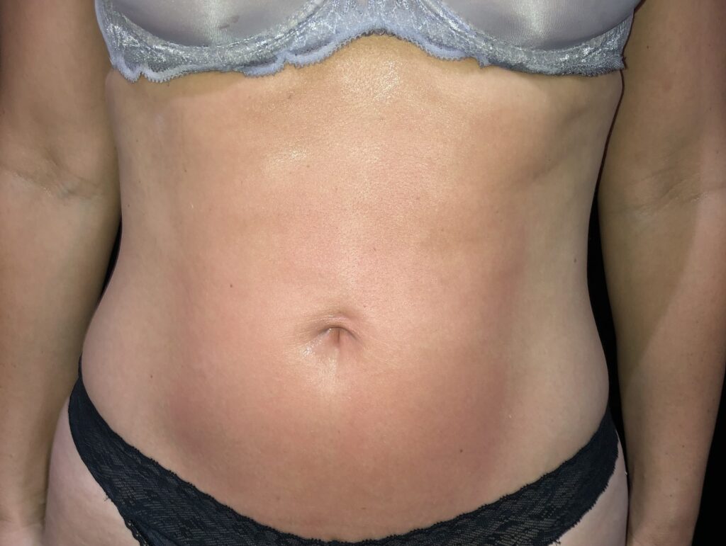 Client receiving T-Shape body sculpting and cellulite reduction treatment at SKIN lounge Aesthetics Richmond, using advanced multi-technology to firm, smooth, and contour the body.
