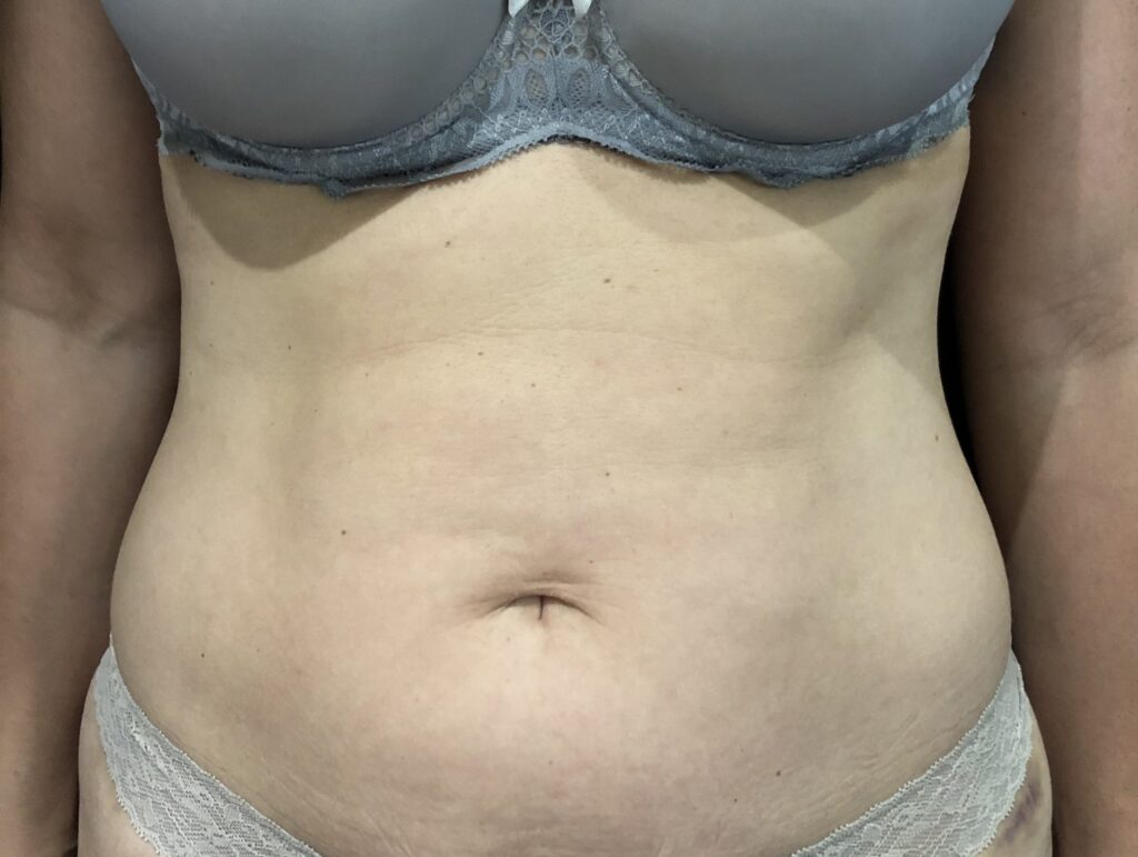 Client receiving T-Shape body sculpting and cellulite reduction treatment at SKIN lounge Aesthetics Richmond, using advanced multi-technology to firm, smooth, and contour the body.