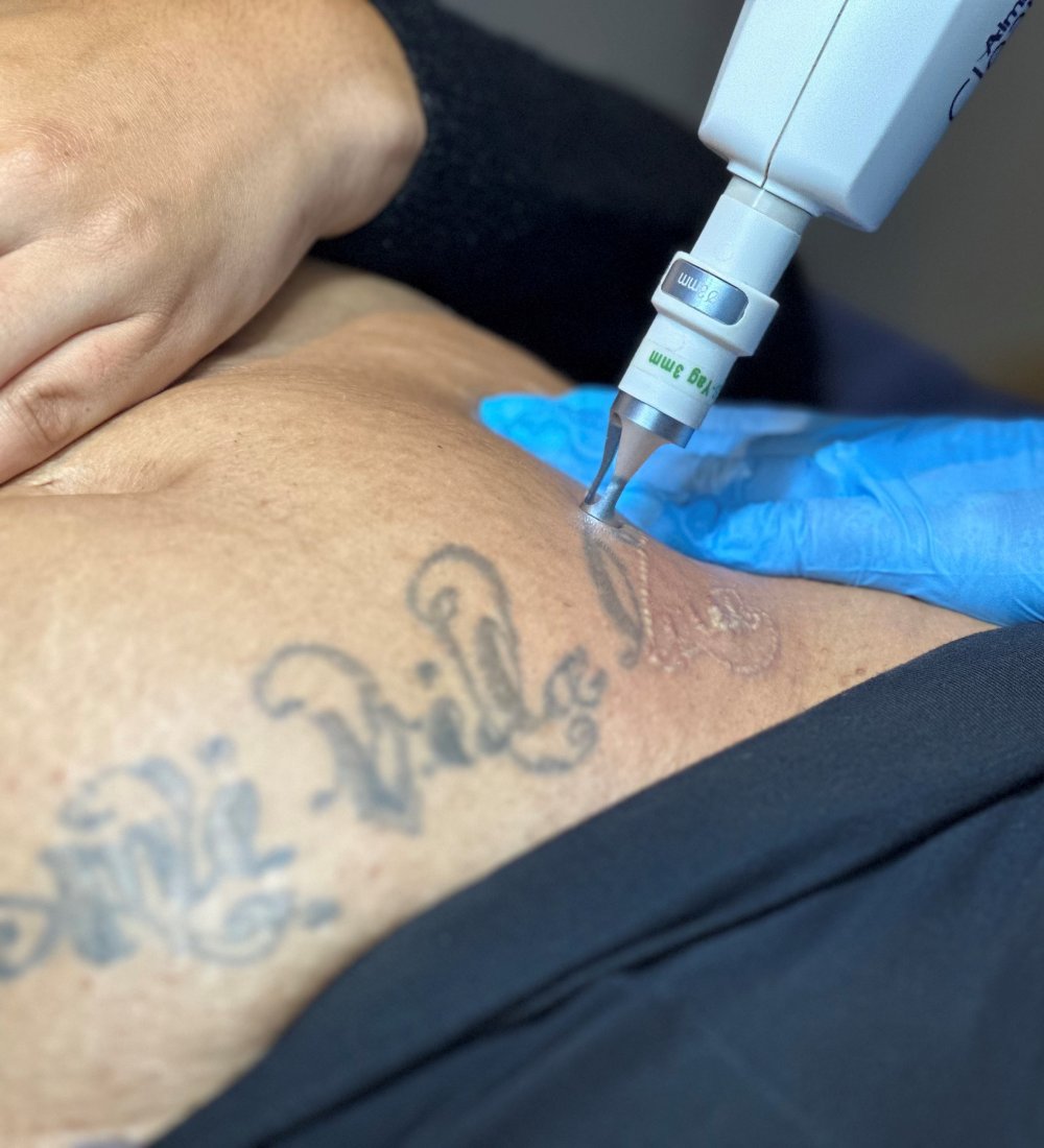 Client receiving laser tattoo removal at SKIN lounge Aesthetics Richmond, using advanced laser technology to safely reduce and remove unwanted ink.
