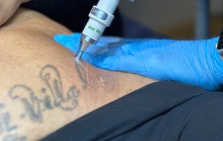 Laser Tattoo Removal – SKIN lounge Aesthetics Richmond Client receiving laser tattoo removal at SKIN lounge Aesthetics Richmond, using advanced laser technology to safely reduce and remove unwanted ink.