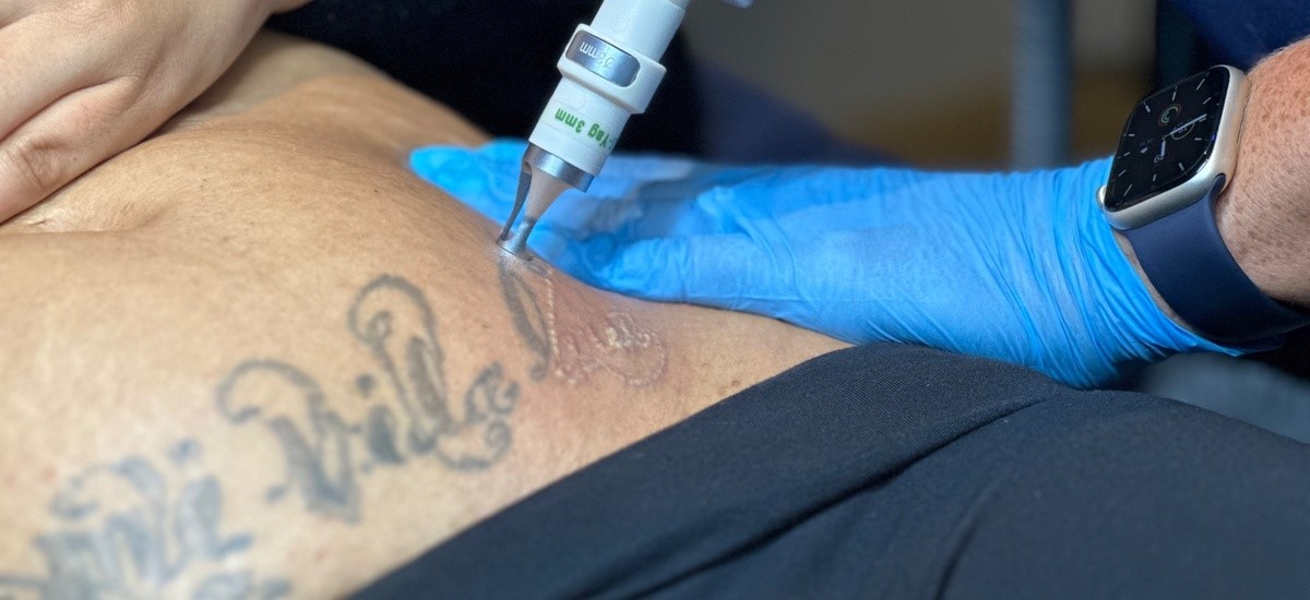Client receiving laser tattoo removal at SKIN lounge Aesthetics Richmond, using advanced laser technology to safely reduce and remove unwanted ink.