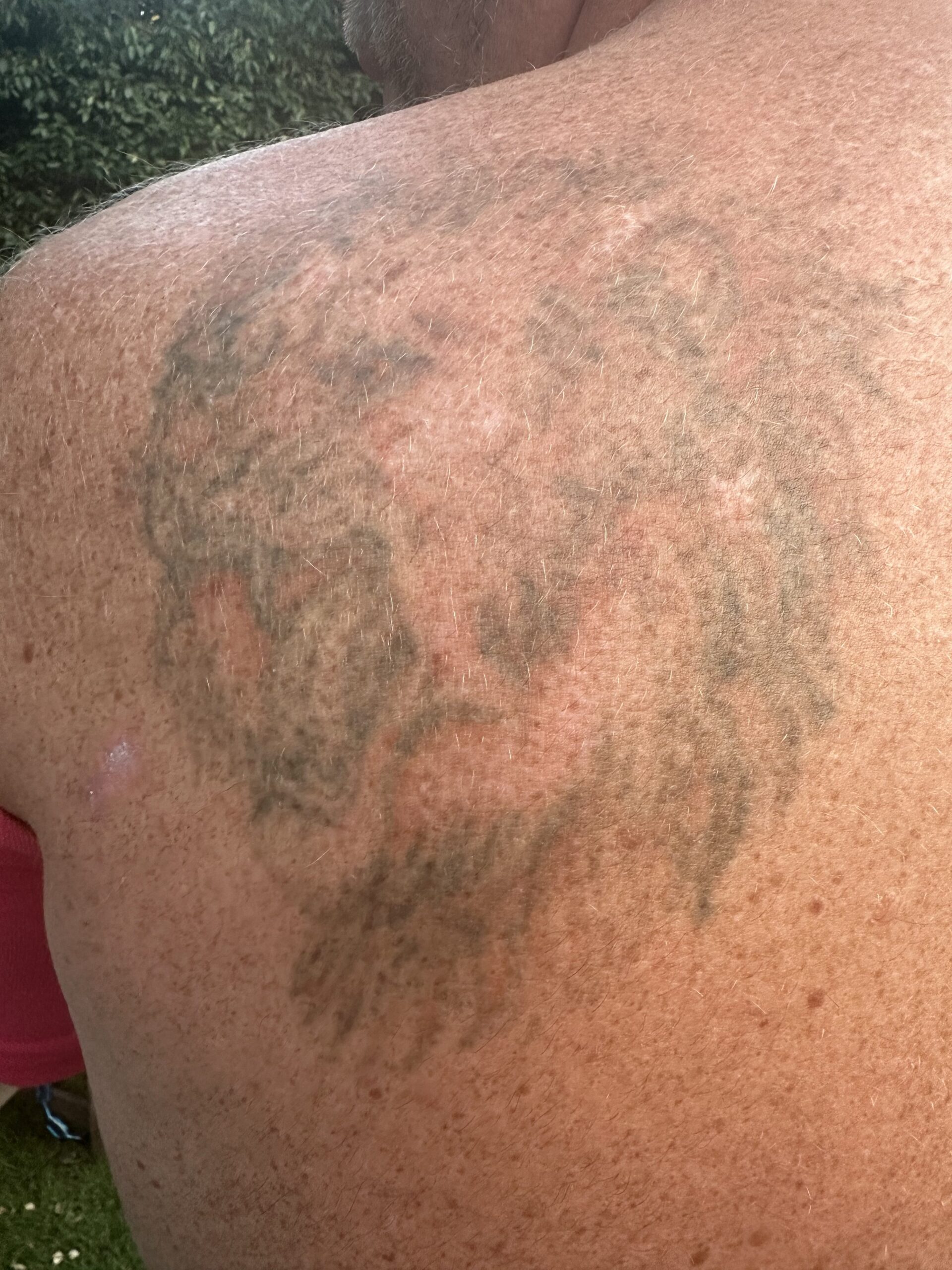 Client receiving laser tattoo removal at SKIN lounge Aesthetics Richmond, using advanced laser technology to safely reduce and remove unwanted ink.
