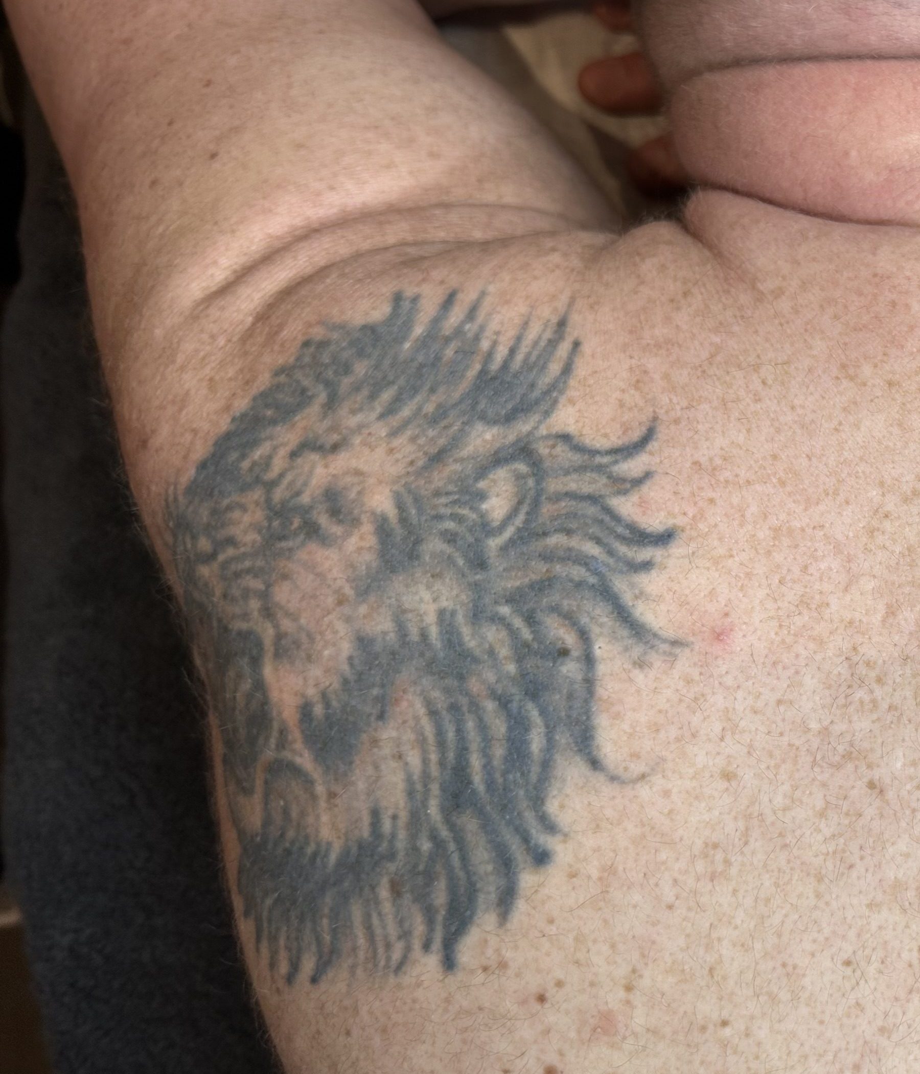 Client receiving laser tattoo removal at SKIN lounge Aesthetics Richmond, using advanced laser technology to safely reduce and remove unwanted ink.
