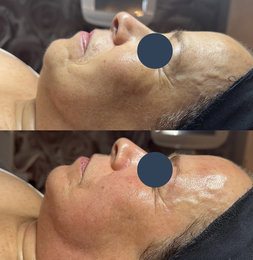 HydraLift before and after Client at SKIN lounge Aesthetics before and after a HydraLift Deluxe treatment