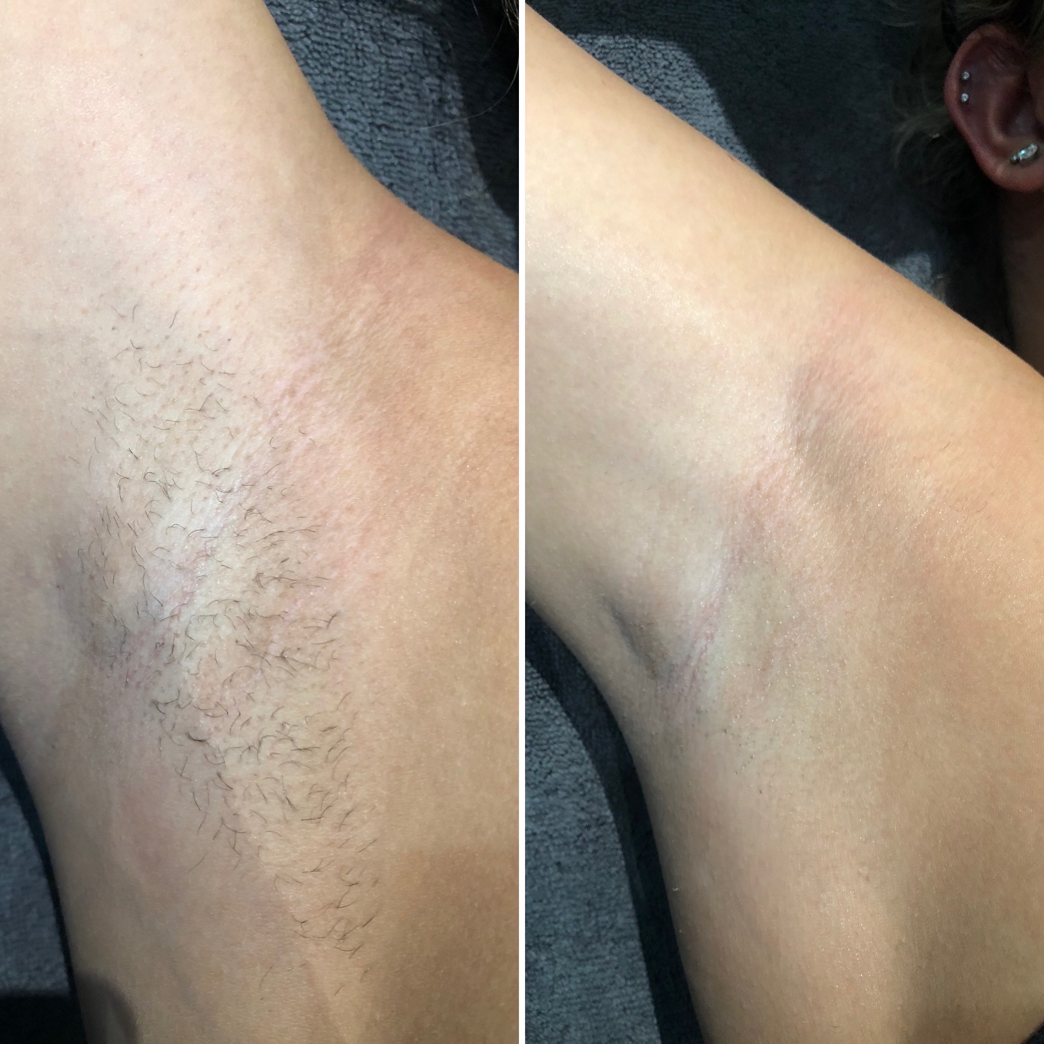 laser hair removal before and after client before and after at SKIN lounge Aesthetics for laser hair removal
