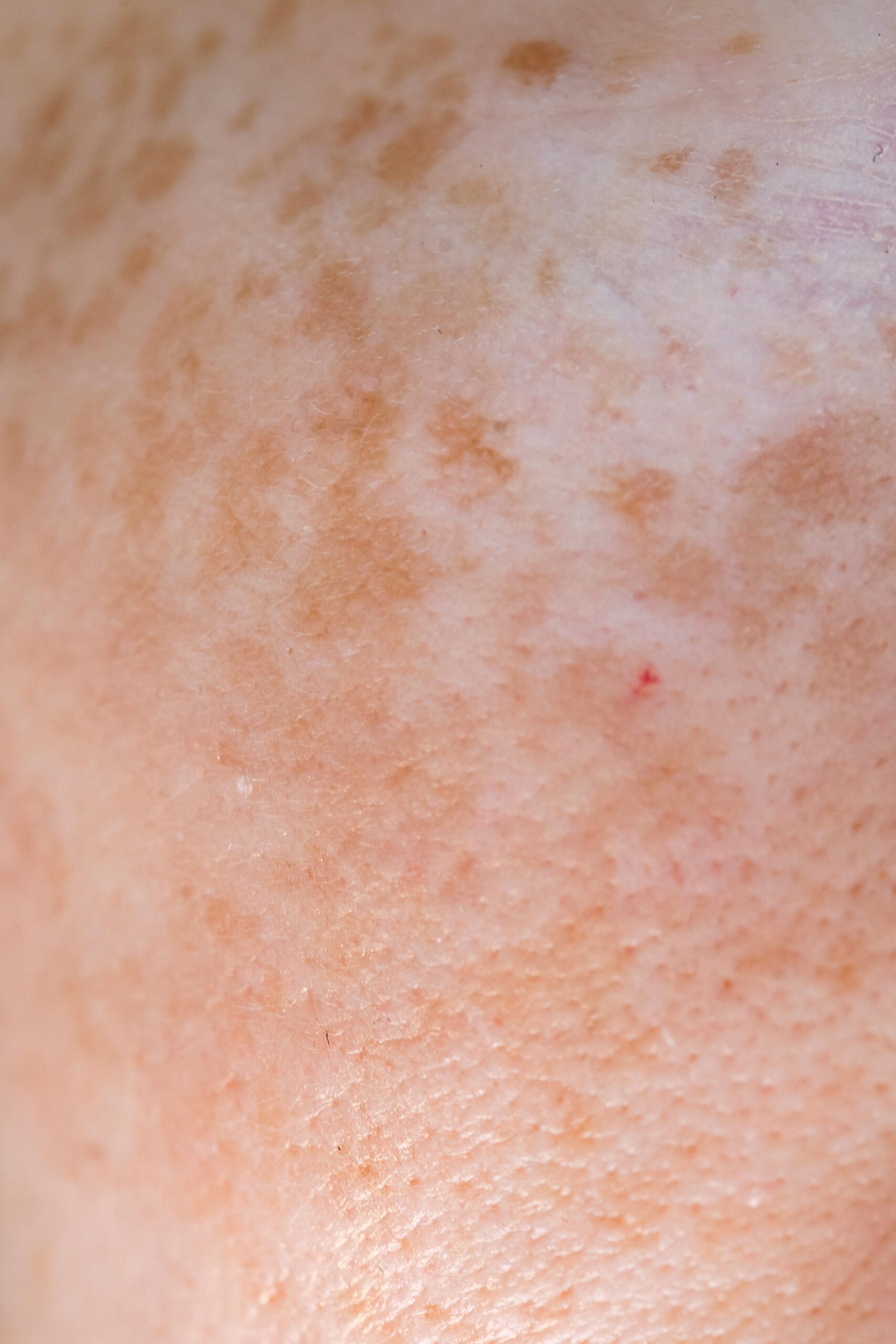 pigmentation & melasma