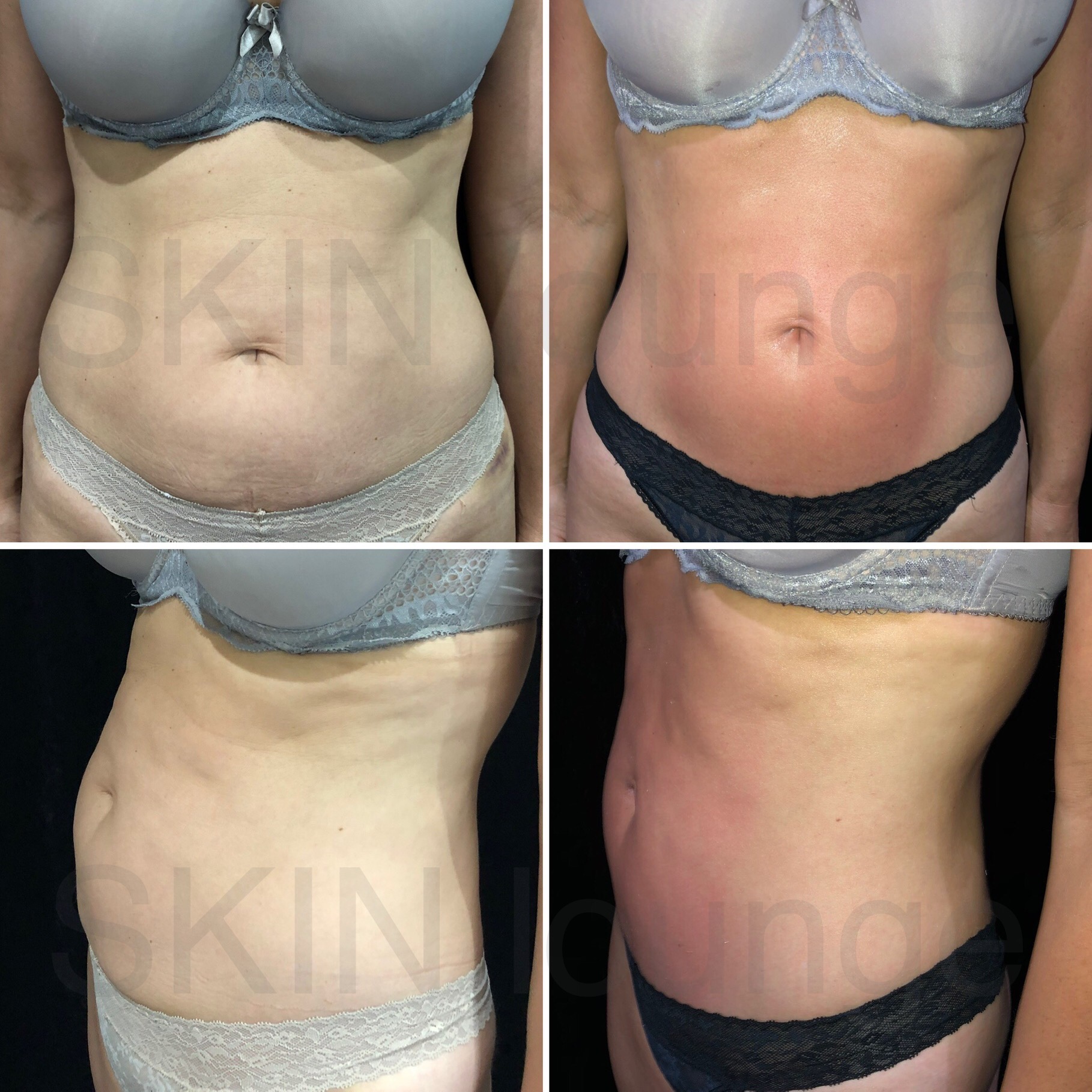 t-shape before and after T-Shape Body Resculpting at SKIN lounge Aesthetics Richmond