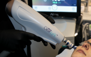 ClearLift Hand Piece Clearlift using the Harmony XL