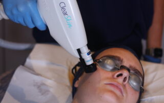 Clearskin laser hydraclean facial using clearskin harmony