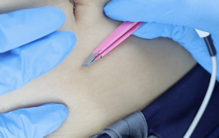 Electrolysis hair removal electrolysis hair removal