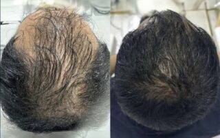 Hair Regeneration using Sylfirm X RF Microneedling plus ASCE exosomes for hair growth Hair Regeneration using Sylfirm X RF Microneedling plus ASCE exosomes for hair growth