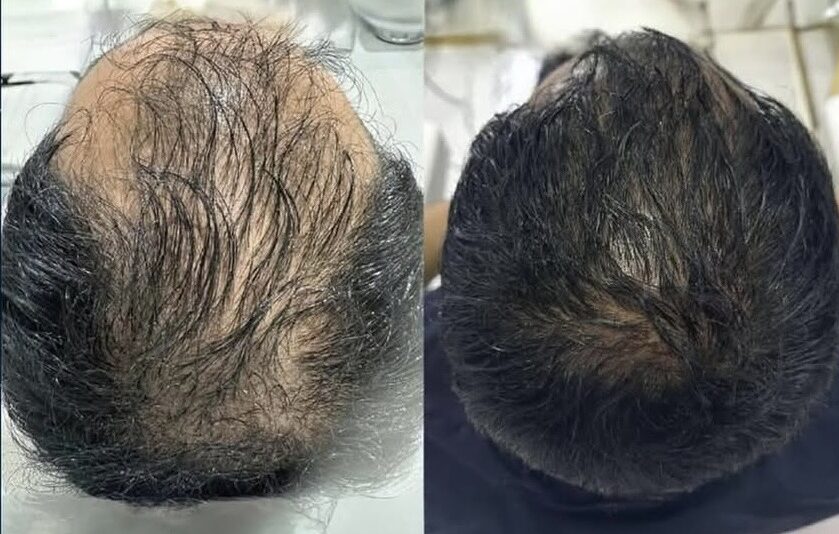 Screenshot hair exosomes in richmond hills skin and aesthetic clinic - promoting hair growth