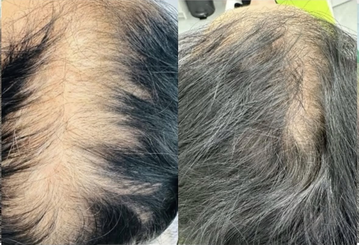 hair exosomes for hair loss. promoting hair growth